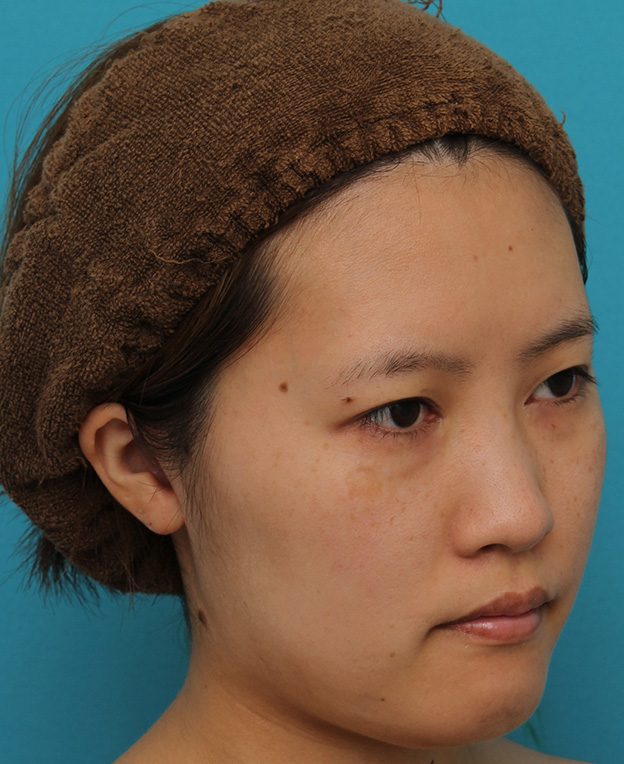 症例写真,ミニフェイスリフトの症例 20代女性の頬を中心としたお顔のたるみの改善,3ヶ月後,mainpic_minilift007j.jpg