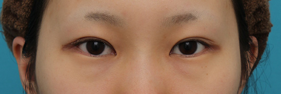 目尻切開と下まぶた逆さまつ毛の同時手術の症例写真,After（3ヶ月後）,ba_mejiri020_a01.jpg