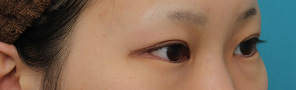 症例写真,目尻切開と下まぶた逆さまつ毛の同時手術の症例写真,After（3ヶ月後）,ba_mejiri020_b02.jpg
