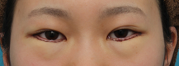 症例写真,目尻切開と下まぶた逆さまつ毛の同時手術の症例写真,手術直後,mainpic_mejiri020b.jpg