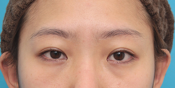 症例写真,他院で切られ過ぎた目頭切開を蒙古襞形成で修正した症例写真,After（6ヶ月後）,ba_hida009_b01.jpg