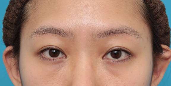 症例写真,他院で切られ過ぎた目頭切開を蒙古襞形成で修正した症例写真,Before,ba_hida009_b01.jpg