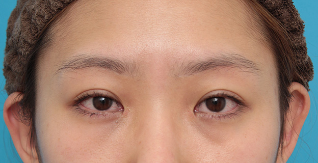 症例写真,他院で切られ過ぎた目頭切開を蒙古襞形成で修正した症例写真,2ヶ月後,mainpic_hida009e.jpg