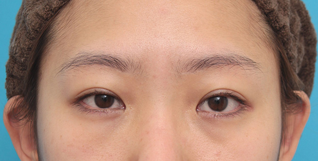 症例写真,他院で切られ過ぎた目頭切開を蒙古襞形成で修正した症例写真,6ヶ月後,mainpic_hida009f.jpg