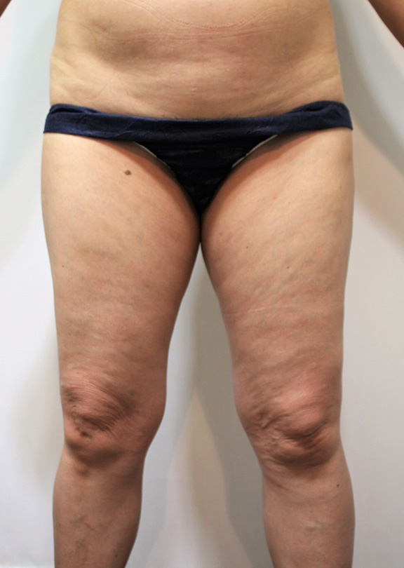 50代女性の太もも全体の脂肪吸引の症例写真,Before,ba_shibokyuin039_b01.jpg