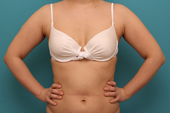 30代女性の肩から二の腕にかけて脂肪吸引を行った症例写真,Before,ba_shibokyuin040_b01.jpg