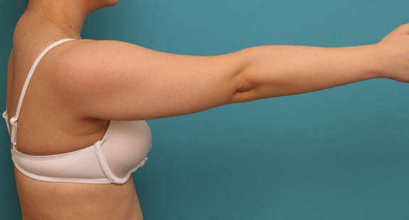 症例写真,30代女性の肩から二の腕にかけて脂肪吸引を行った症例写真,Before,ba_shibokyuin040_b03.jpg