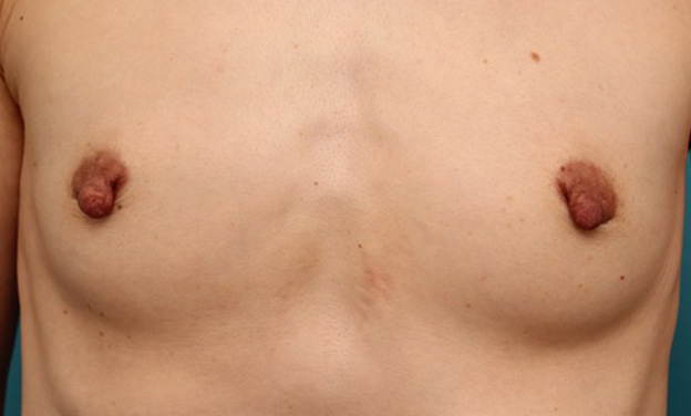 症例写真,40代女性の、授乳によって伸びて垂れ下がってしまった乳頭を縮小した症例写真,手術前,mainpic_nyuto019a.jpg