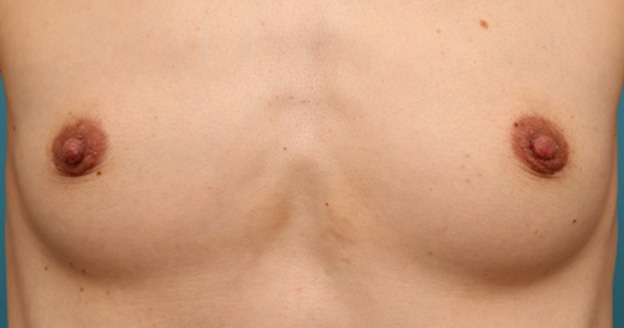 症例写真,40代女性の、授乳によって伸びて垂れ下がってしまった乳頭を縮小した症例写真,2週間後,mainpic_nyuto019c.jpg