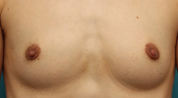 症例写真,40代女性の、授乳によって伸びて垂れ下がってしまった乳頭を縮小した症例写真,6ヶ月後,mainpic_nyuto019e.jpg