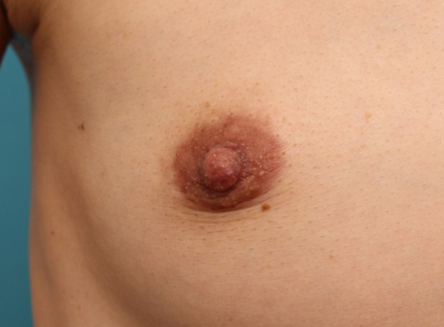 症例写真,40代女性の、授乳によって伸びて垂れ下がってしまった乳頭を縮小した症例写真,2週間後,mainpic_nyuto019h.jpg