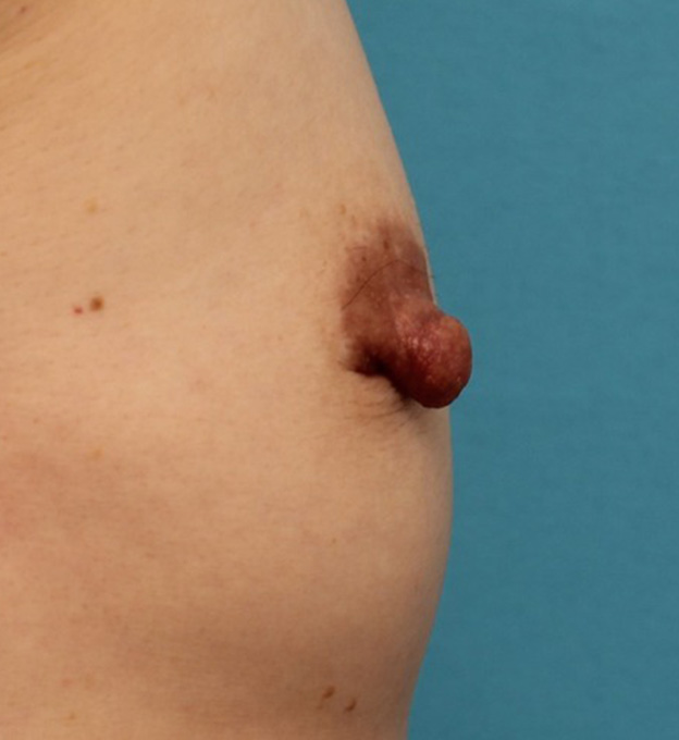 症例写真,40代女性の、授乳によって伸びて垂れ下がってしまった乳頭を縮小した症例写真,手術前,mainpic_nyuto019p.jpg