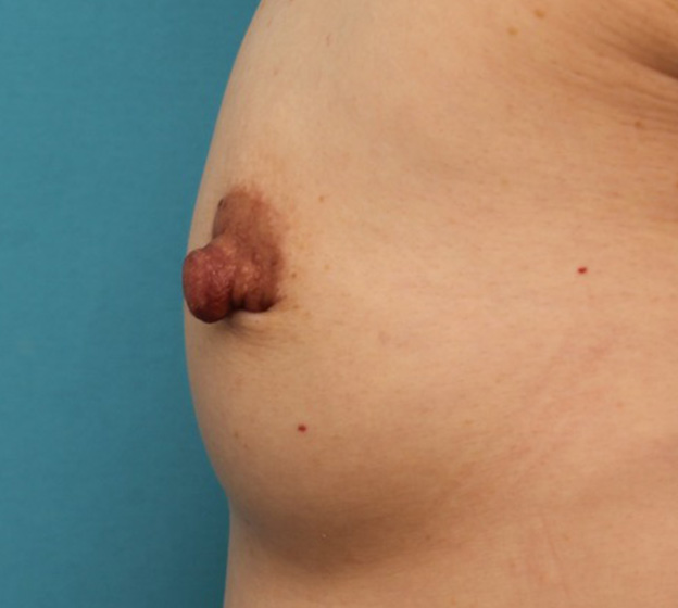 症例写真,40代女性の、授乳によって伸びて垂れ下がってしまった乳頭を縮小した症例写真,手術前,mainpic_nyuto019s.jpg