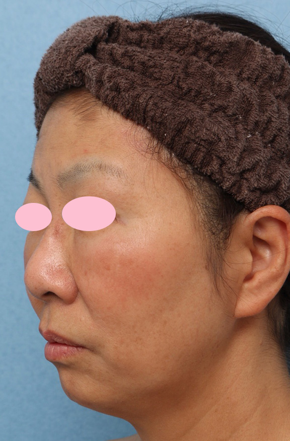 症例写真,ヒアルロン酸3本ですっきりVシェイプリフトした症例写真,Before,ba_v_shapelift011_b02.jpg