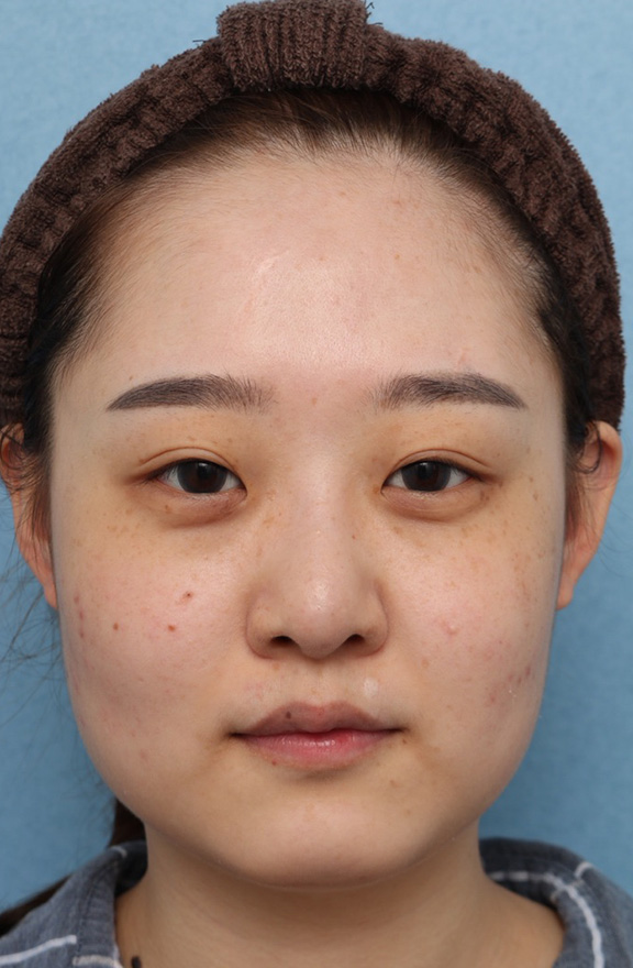 小顔専用脂肪溶解注射メソシェイプフェイスで少しだけ顔をすっきりさせた症例写真,After（2回施術4ヶ月後）,ba_meso_face010_a01.jpg