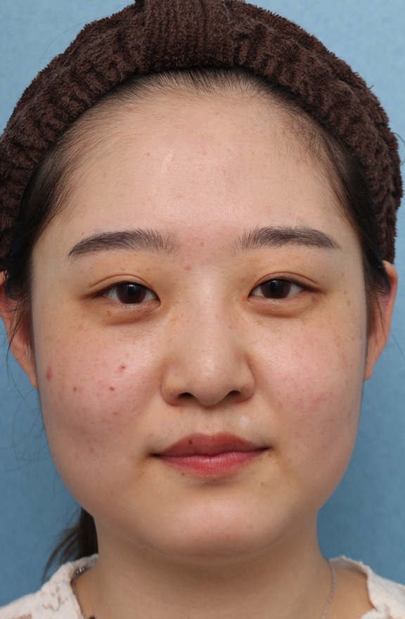 症例写真,小顔専用脂肪溶解注射メソシェイプフェイスで少しだけ顔をすっきりさせた症例写真,Before,ba_meso_face010_b01.jpg