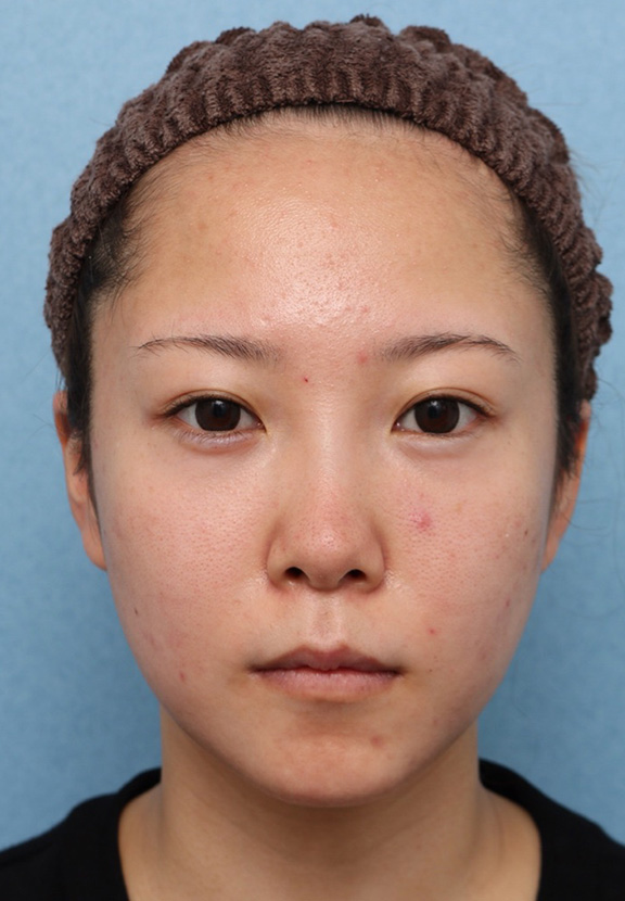 症例写真,ウルセラと顔の脂肪溶解注射のコンビネーションで2ヶ月で頬がホッソリした症例写真,After（2ヶ月後）,ba_ulthera030_b01.jpg