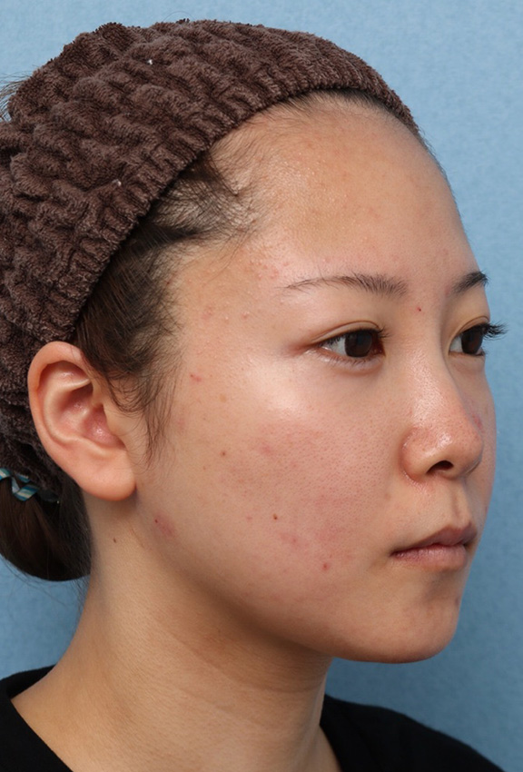 症例写真,ウルセラと顔の脂肪溶解注射のコンビネーションで2ヶ月で頬がホッソリした症例写真,After（2ヶ月後）,ba_ulthera030_b02.jpg