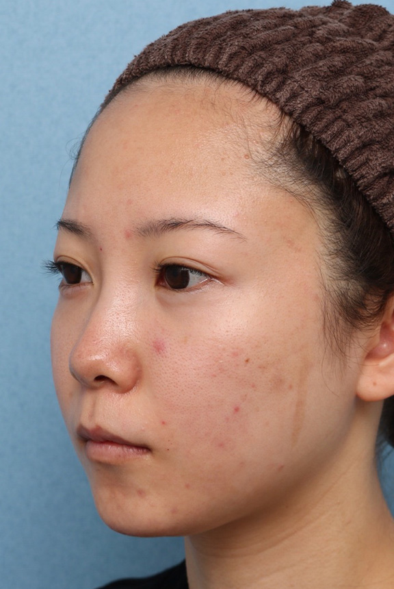 症例写真,ウルセラと顔の脂肪溶解注射のコンビネーションで2ヶ月で頬がホッソリした症例写真,After（2ヶ月後）,ba_ulthera030_b03.jpg