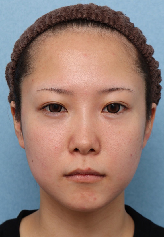 症例写真,ウルセラと顔の脂肪溶解注射のコンビネーションで2ヶ月で頬がホッソリした症例写真,Before,ba_ulthera030_b01.jpg