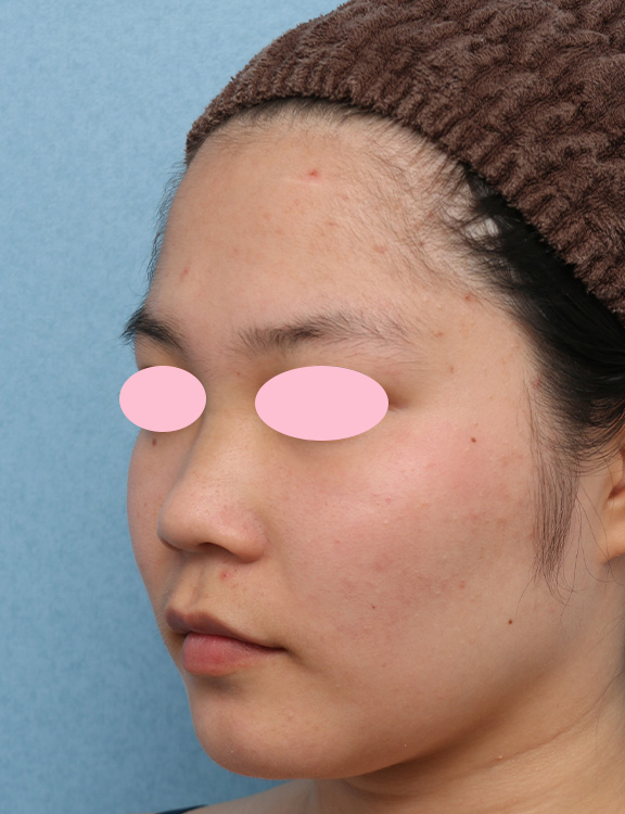 症例写真,鼻を高くするヒアルロン酸注射の症例写真,Before,ba_ryubi2035_b01.jpg