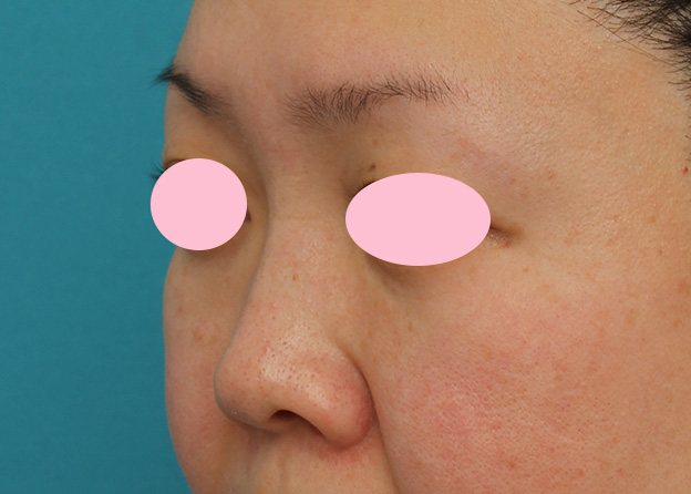 症例写真,ヒアルロン酸による隆鼻術の症例写真,1ヶ月後,mainpic_ryubi2032l.jpg