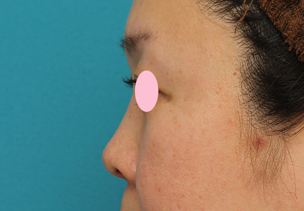 症例写真,ヒアルロン酸による隆鼻術の症例写真,1ヶ月後,mainpic_ryubi2032o.jpg