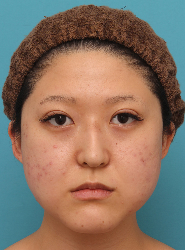 症例写真,バッカルファット除去で小顔になった20代女性の症例写真,手術直後,mainpic_buccalfat017b.jpg