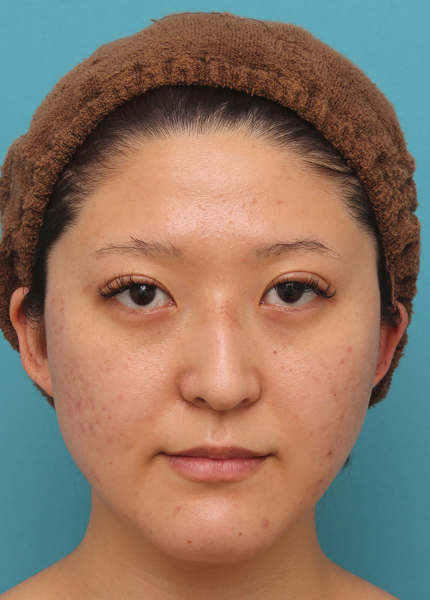 症例写真,バッカルファット除去で小顔になった20代女性の症例写真,6日後,mainpic_buccalfat017c.jpg