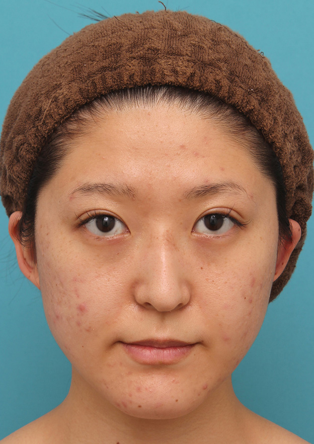バッカルファット除去,バッカルファット除去で小顔になった20代女性の症例写真,6ヶ月後,mainpic_buccalfat017d.jpg