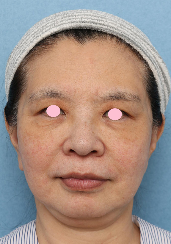 顔の脂肪溶解注射の症例写真,After（4ヶ月後、注射2回目前）,ba_meso_face012_a01.jpg