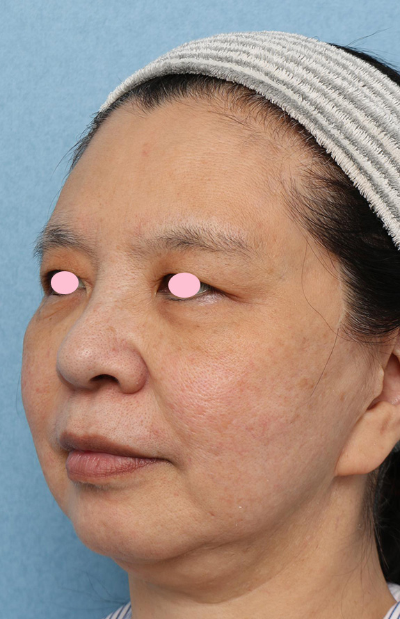 症例写真,顔の脂肪溶解注射の症例写真,After（4ヶ月後、注射2回目前）,ba_meso_face012_b02.jpg
