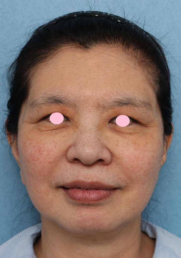 症例写真,顔の脂肪溶解注射の症例写真,Before,ba_meso_face012_b01.jpg