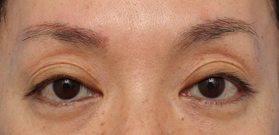 上まぶたのくぼみ目ヒアルロン酸注射の症例写真,Before,ba_kubomi006_b01.jpg