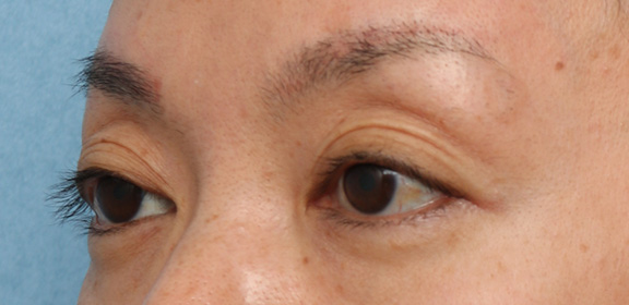 症例写真,上まぶたのくぼみ目ヒアルロン酸注射の症例写真,Before,ba_kubomi006_b02.jpg