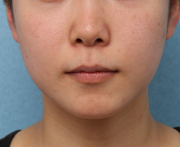 小顔専用脂肪溶解注射メソシェイプフェイス,メソシェイプフェイスの症例写真,After（3ヶ月後）,ba_meso_face013_a01.jpg