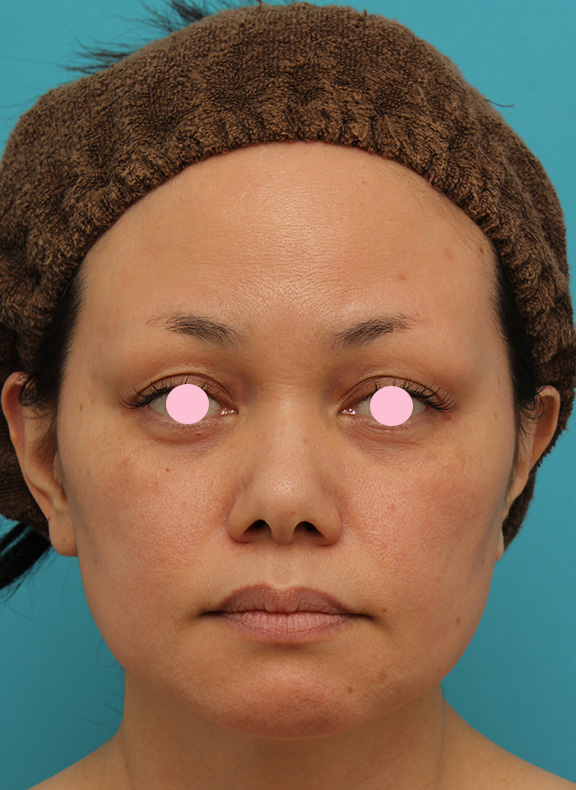 あご注射（ヒアルロン酸）,40代女性患者様に長期持続型ヒアルロン酸を2本（2cc）入れて顎を作った症例写真,Before,ba_agochu015_b01.jpg