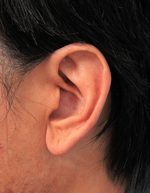 大きな耳たぶを縮小手術で小さくした症例写真,Before,ba_other009_b01.jpg