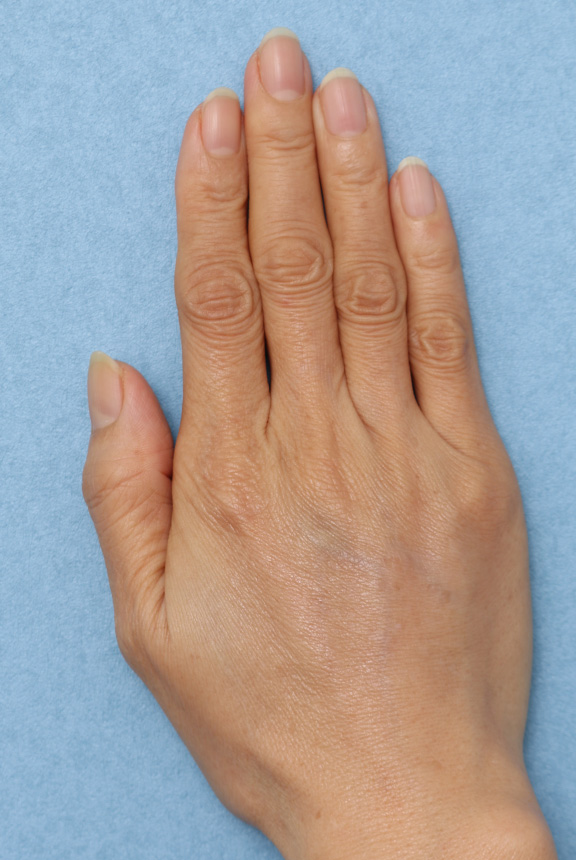 注射式シワ取り 長期持続型ヒアルロン酸注入,手の甲ヒアルロン酸注射の症例写真,After（2回目注射、1ヶ月後）,ba_hyaluronic035_a01.jpg