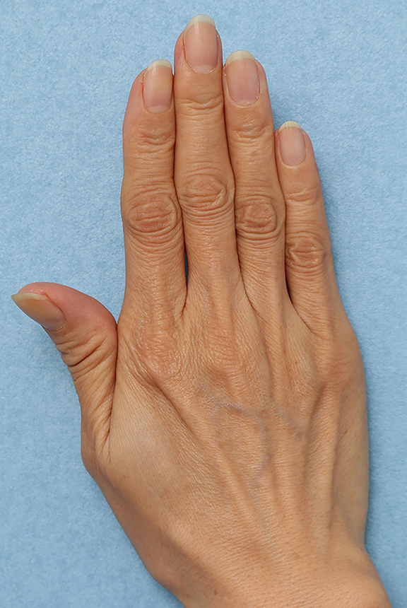 注射式シワ取り 長期持続型ヒアルロン酸注入,手の甲ヒアルロン酸注射の症例写真,Before,ba_hyaluronic035_b01.jpg