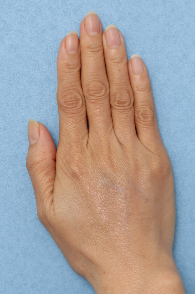 症例写真,手の甲ヒアルロン酸注射の症例写真,2回目注射、1ヶ月後,mainpic_hyaluronic035c.jpg