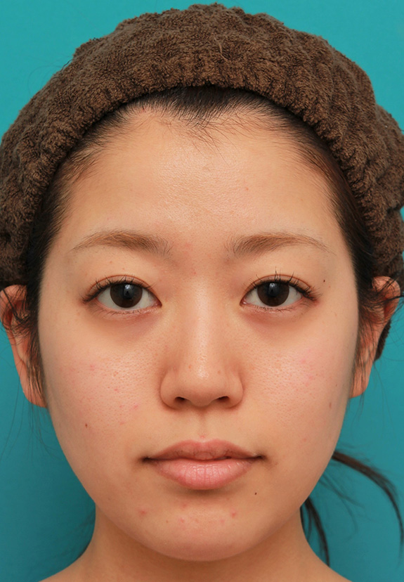 症例写真,メソシェイプフェイス（顔専用の脂肪溶解注射）で小顔になった20代女性の症例写真,After（3回注射後）,ba_meso_face014_b01.jpg