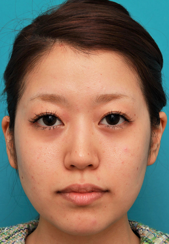 メソシェイプフェイス（顔専用の脂肪溶解注射）で小顔になった20代女性の症例写真,Before,ba_meso_face014_b01.jpg