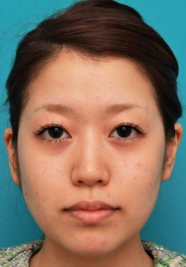 症例写真,メソシェイプフェイス（顔専用の脂肪溶解注射）で小顔になった20代女性の症例写真,治療前,mainpic_meso_face014a.jpg