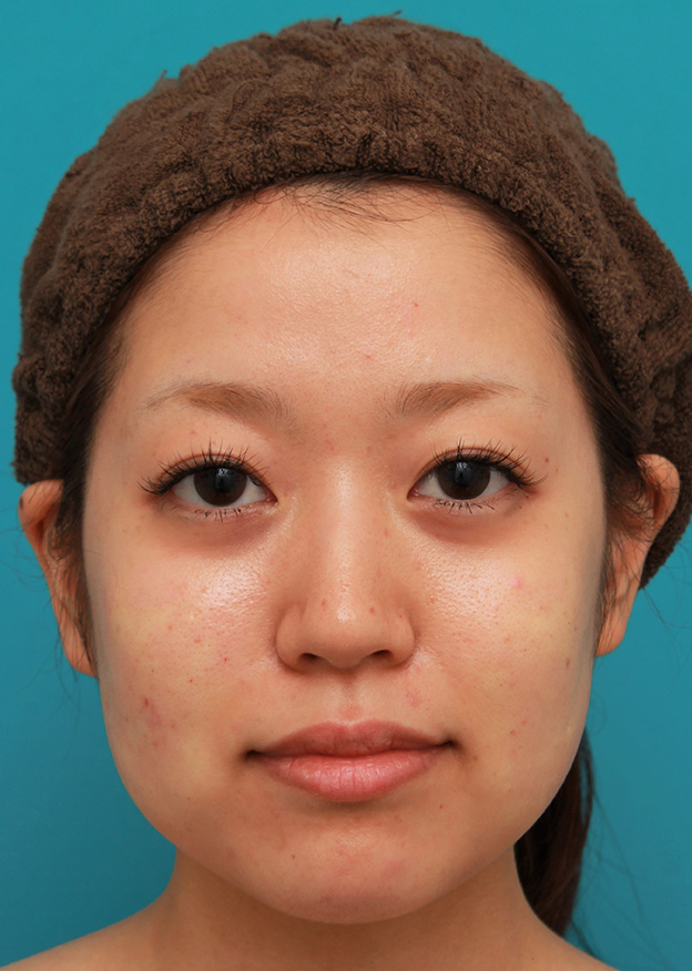 症例写真,メソシェイプフェイス（顔専用の脂肪溶解注射）で小顔になった20代女性の症例写真,1回目注射直後,mainpic_meso_face014b.jpg