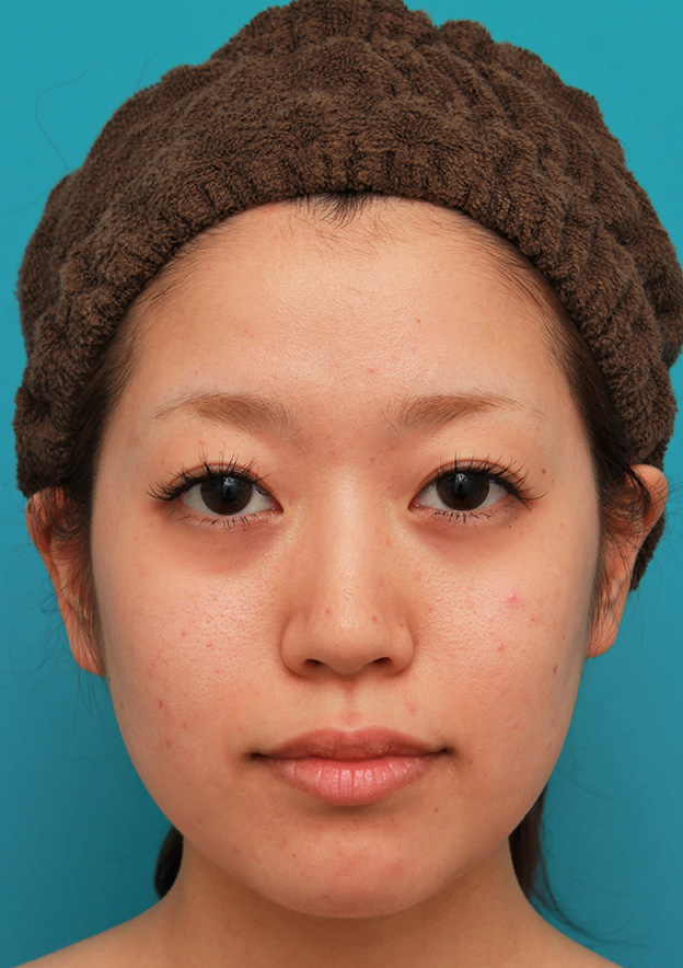 症例写真,メソシェイプフェイス（顔専用の脂肪溶解注射）で小顔になった20代女性の症例写真,2回目注射後,mainpic_meso_face014d.jpg