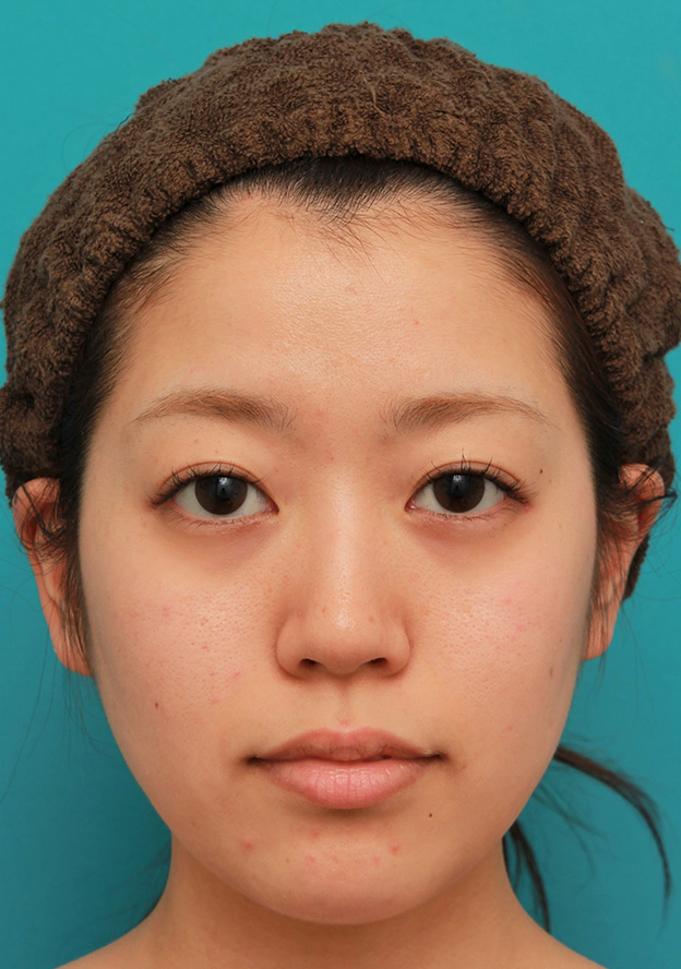 症例写真,メソシェイプフェイス（顔専用の脂肪溶解注射）で小顔になった20代女性の症例写真,3回目注射後,mainpic_meso_face014e.jpg