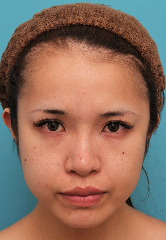 症例写真,上口唇にヒアルロン酸注射をし、アヒル口っぽくして鼻の下が短く見えるようになった症例写真,After（1ヶ月後）,ba_atsuku017_b01.jpg