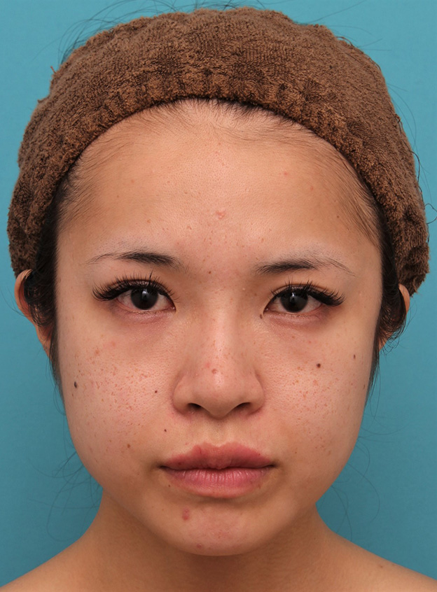 症例写真,上口唇にヒアルロン酸注射をし、アヒル口っぽくして鼻の下が短く見えるようになった症例写真,注射直後,mainpic_atsuku017b.jpg
