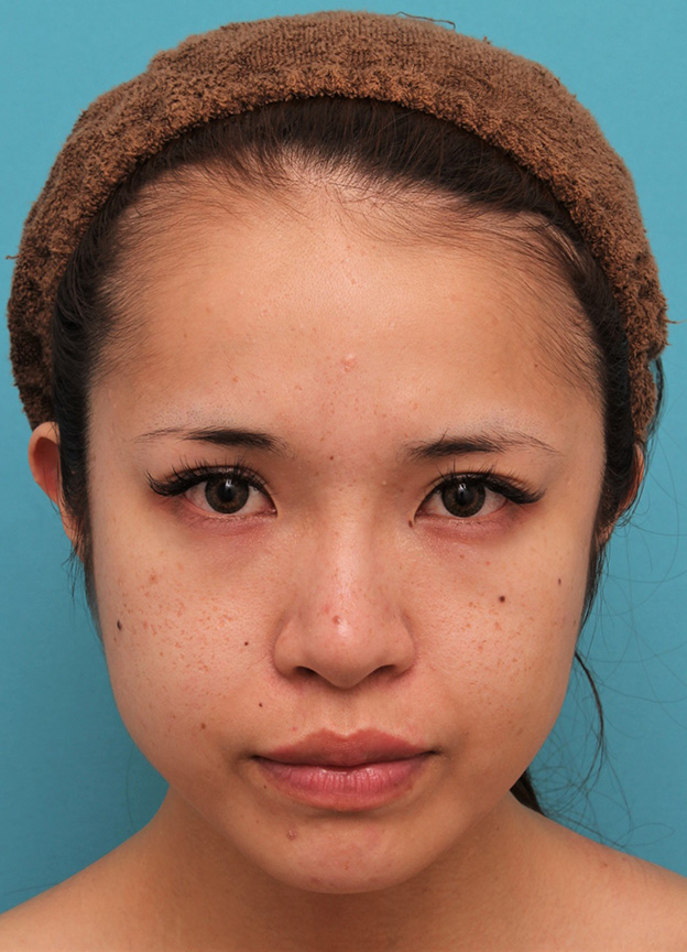 症例写真,上口唇にヒアルロン酸注射をし、アヒル口っぽくして鼻の下が短く見えるようになった症例写真,1ヶ月後,mainpic_atsuku017d.jpg